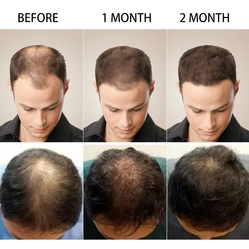 Hair Growth Serum Anti-loss Hair For Women Men